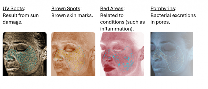 VISIA-CR spots, wrinkles, texture, pores, UV spots, brown spots, red areas and porphyrins.
