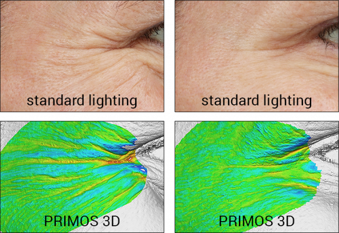 VISIA-CR and PRIMOS 3D results